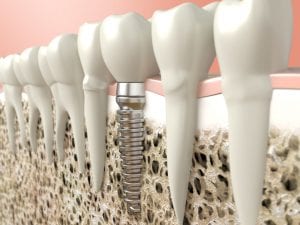 affordable dental implants